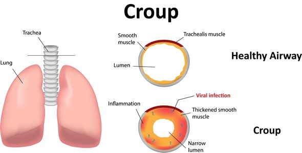 Croup - Image Copyright: joshya / Shutterstock